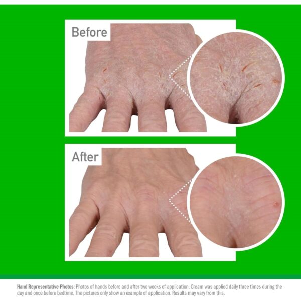 O’Keeffe’s Working Hands Eczema Relief Hand Cream 57g – Soothing Moisturizer for Dry, Itchy, Irritated Skin